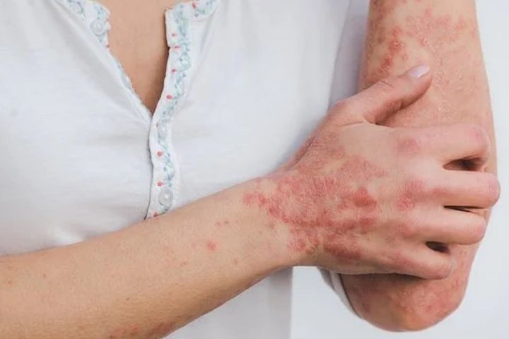 Eczema